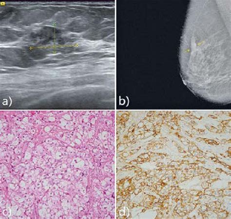A Breast Ultrasound Hypoechoic Nodule With Unclear Boundaries And