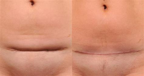 C Section Scar Removal New York City