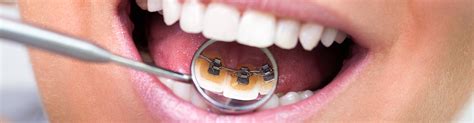 Invisible Lingual Braces In Houston Tx Orthodontic Treatment Near Me