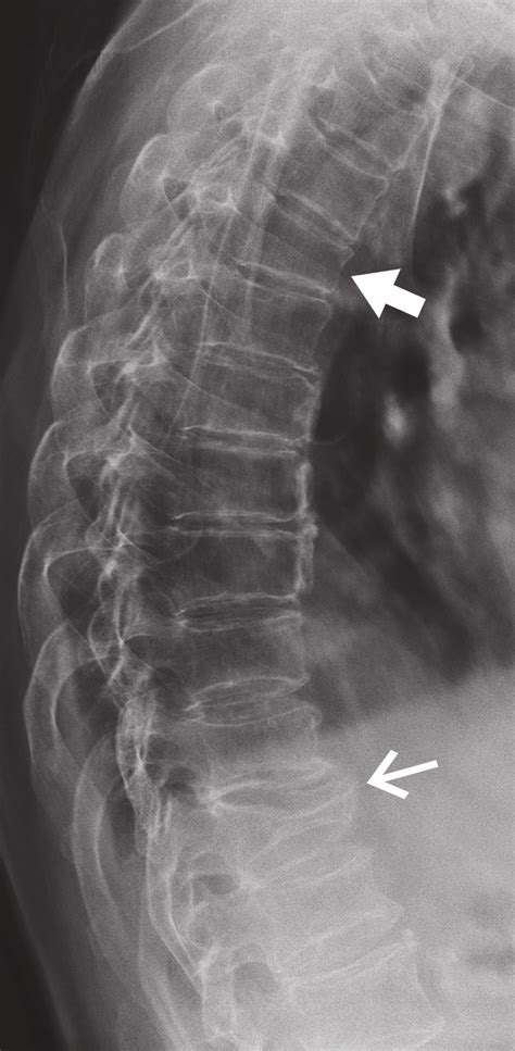 Lateral Thoracic Spine Radiograph There Is A Severe Fracture Of The