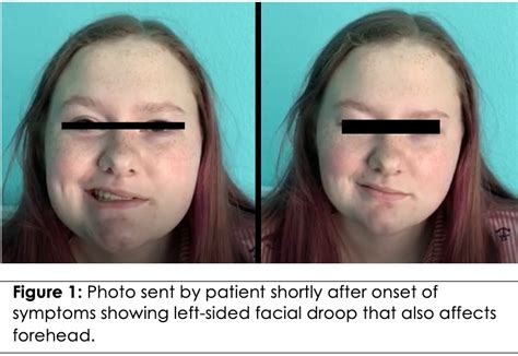 Facial Nerve Palsy After Occipital Nerve Blocks — A Case Report
