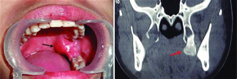 A Intra Oral Submucosal Bony Hard Swelling On Left Side Of Soft