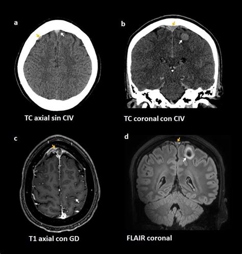 Trombosis Venosa Cerebral Con Infarto Venoso Poco Convencional SERAU