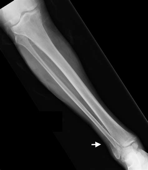 Cureus Critical Finding Of Wellens Syndrome In A Patient Who Presented With A Fibular Fracture