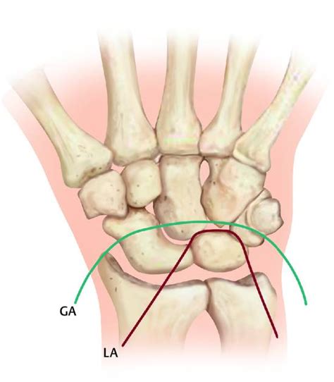 Perilunate Dislocations Musculoskeletal Key