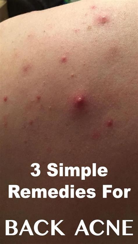 3 Best Remedies For Back Acne In 2020 Back Acne Remedies Acne Body Acne