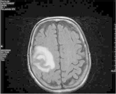 Mr Imaging Showing A Proliferative Lesion On Right Fronto Rolandic