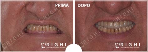 Casi Clinici Studio Dentistico Righi Parma E Rivalta Righi Ambulatori