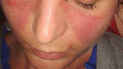 Skin Disorders Pictures Causes Symptoms Treatments And Prevention