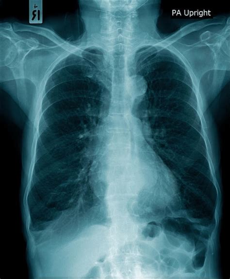 Image Radiographique Humaine Radiographie Pulmonaire à L intérieur Du