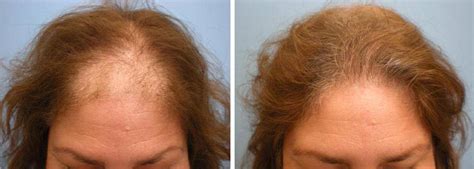 Five Easy Steps To Female Hair Loss Management L Parsa Mohebi