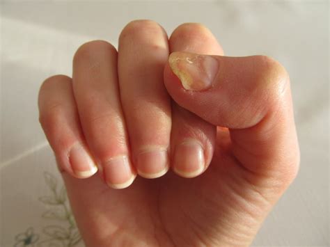 Toenail fungus and fingernail fungus can cause inflammation around the nail (paronychia) as well as lifting of the nail plate from the nail bed (onycholysis). Explainer: why do we get fungal nail infections and how ...