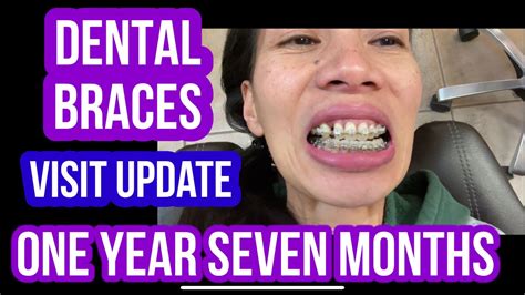Dental Braces My Latest Visit After One Year Seven Months Wearing