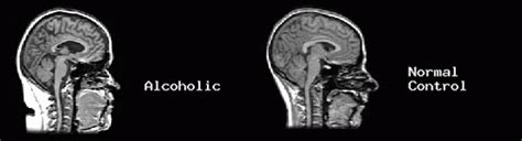 Inside The Alcoholic Brain The Psychology And Neuropsychology Of Alcoholism Addictive