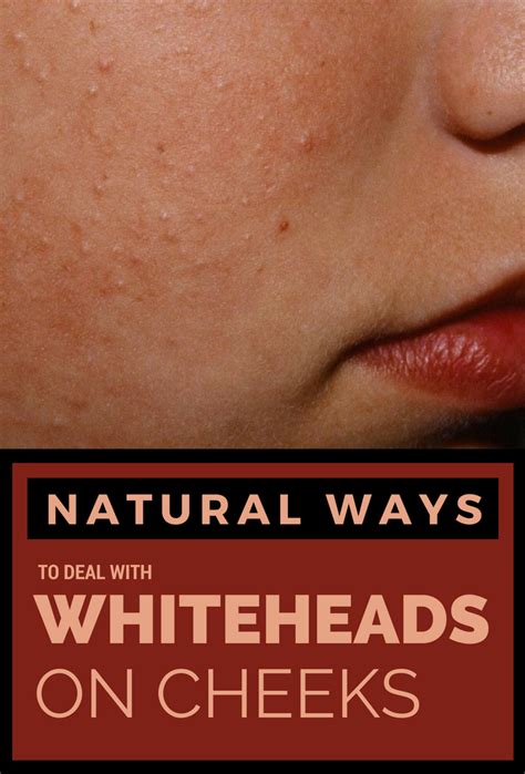 Skin Care Tips For Beautiful Skin Whiteheads Whiteheads Remedy Cheek