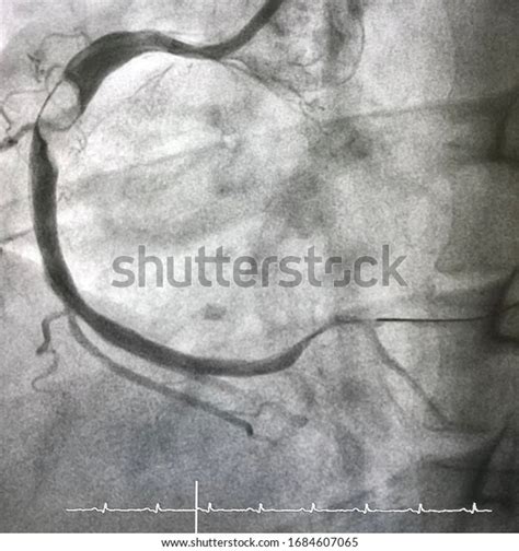 Coronary Angiogram Shown That Massive Thrombus Stock Photo 1684607065