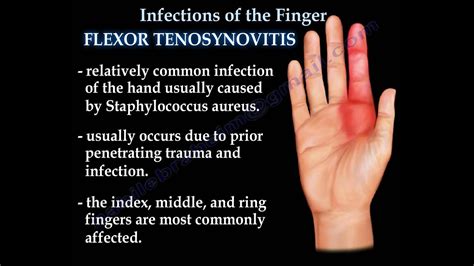 Cellulitis Fascitis Infection Tendon Sheath Infection Finger