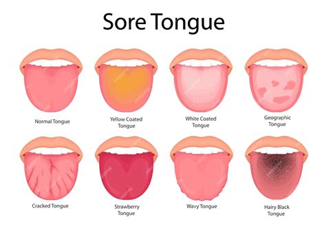 Premium Vector Illustration Of Tongue Symptoms And Health Medical