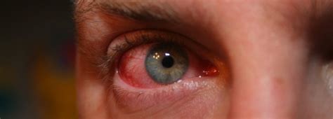 Scratched Cornea Or Viral Pink Eye How To Tell The Difference