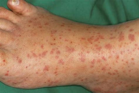 What Causes Rash On Legs Pictures Photos