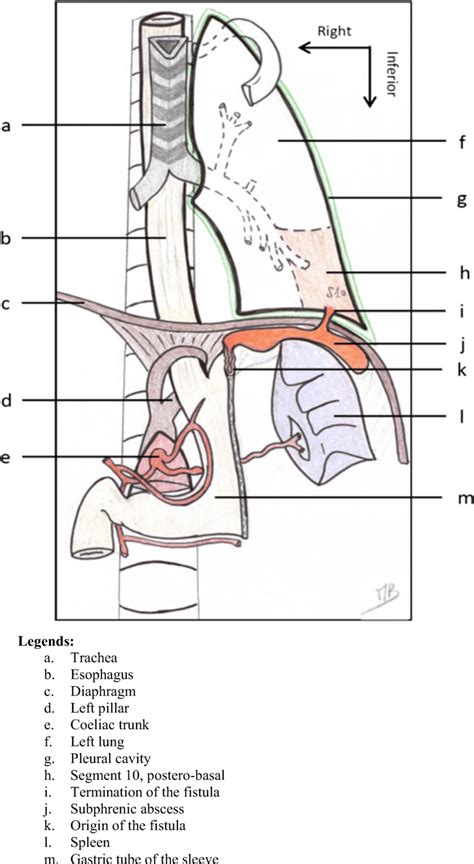 Anatomical Representation Of The Gastro Bronchial Fistula After Sleeve