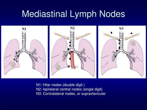 Hilar Lymph Nodes Lung Cancer
