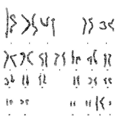 G Banded Karyogram Of The Patient Showing A 47xxy Karyotype