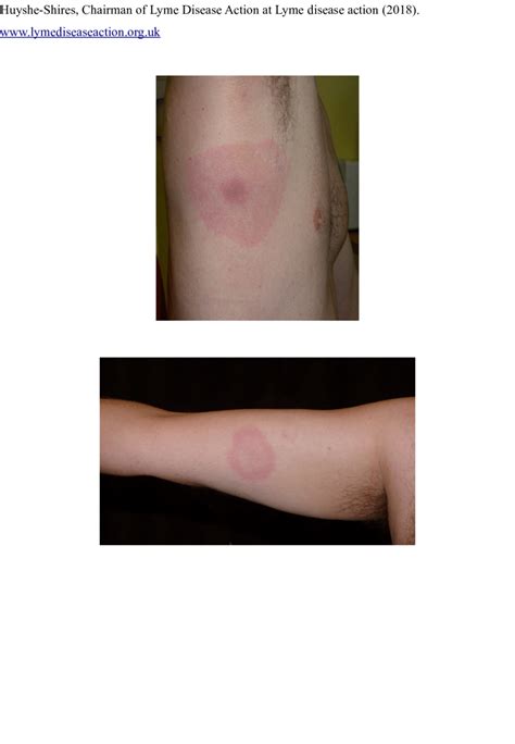 Pictures Of Erythema Migrans A The Axilla Region B On The Arm