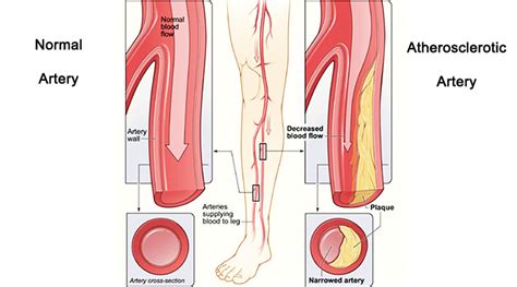 Peripheral Artery Disease Symptoms And Risks 50 World 50 World