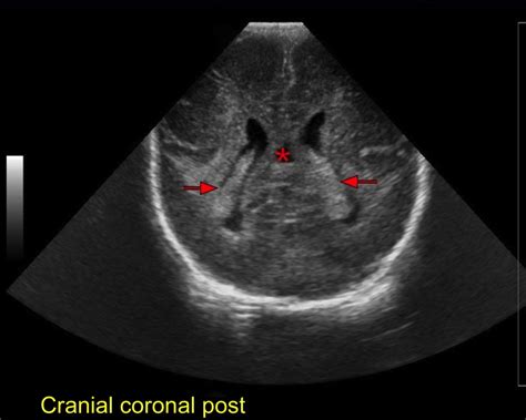 Normal Neonatal Brain Sonography Of A Preterm Newborn In Posterior