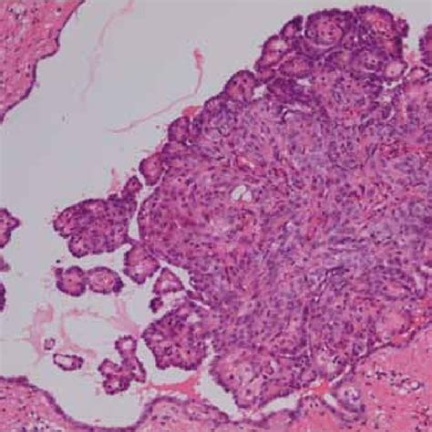 Histological Features Of The Malignant Mesothelioma Papillary