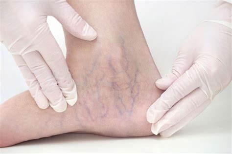 How To Get Rid Of Spider Veins Harmony Medspa