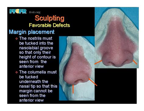 23restoration Of Nasal Defects