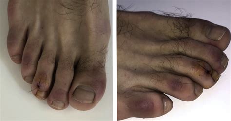 Covid Toes And Other Skin Symptoms May Be A Sign Of Coronavirus Cbs