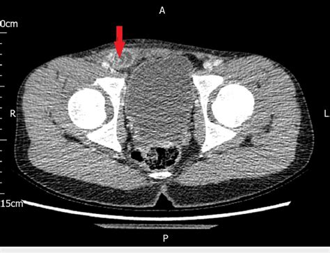 Ct Axial View Showing The Right Sided Inguinal Hernia Containing The