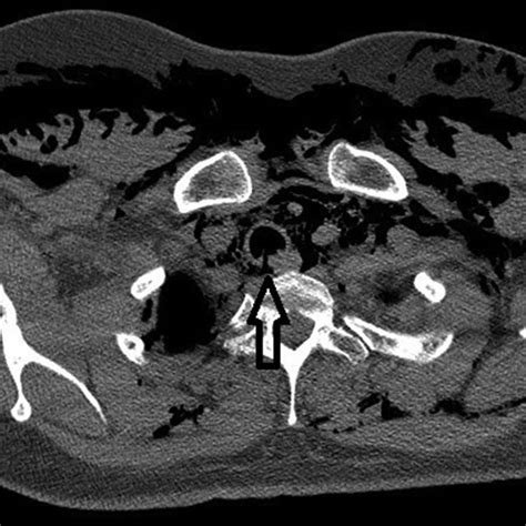 Chest Ct Showing Linear Tracheal Rupture In Posterior Wall Arrow