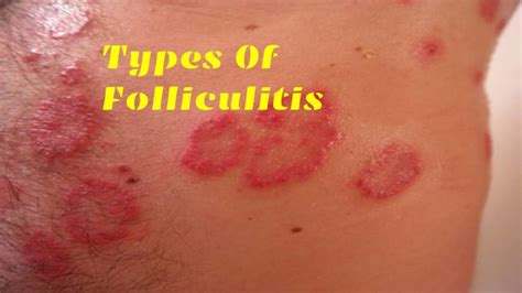 Folliculitis What Is Folliculitis Its Symptoms Causes And More