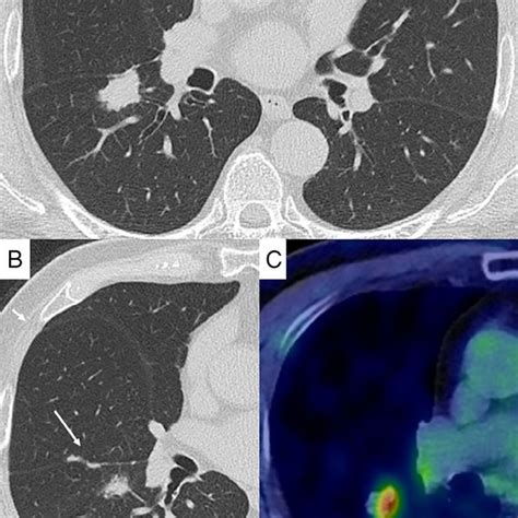 A B Chest Computed Tomography Ct Scan Showed A Lung Nodule