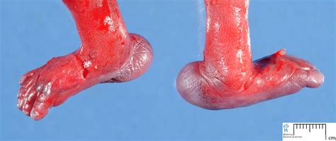 Rocker Bottom Feet Human Pathology