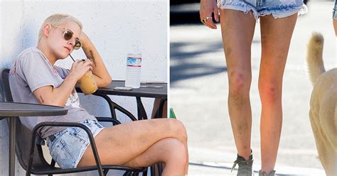 Kristen Stewart Shows Mystery Bruises On Her Legs In New Orleans