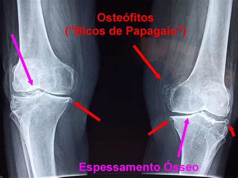 O Que é Osteófitos No Joelho Dr Márcio Silveira Ortopedia E