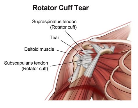 Rotator Cuff Tear Dr Sarda
