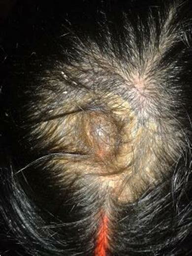 Rock Hard Cone Shaped Elevated Lesion Of Rupioid Psoriasis On Scalp