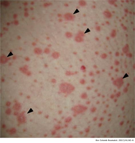 Leflunomide Induced Stevens Johnson Syndrome In A Patient With Systemic