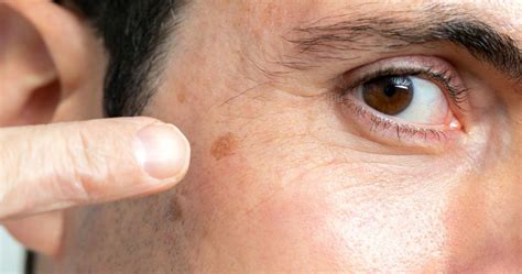 Common Dark Spots On The Face Advanced Dermatology Of The Midlands