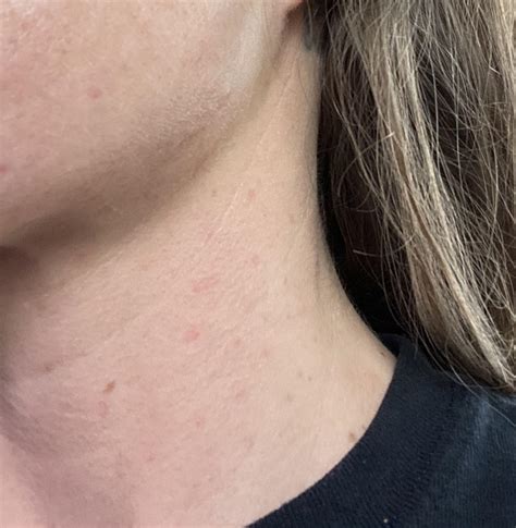 Skin Concern Small Red Dots On Neck No Itchingburning No New