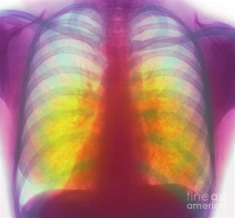 Tuberculosis X Ray Photograph By Simon Fraserscience Photo Library