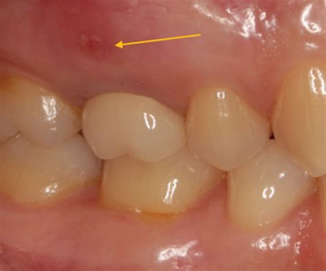 Immediate Loading Of Straumann® Tlx Implant In Grafted Maxillary First