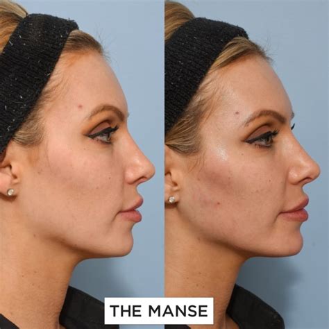 Chin Fillers Before And After