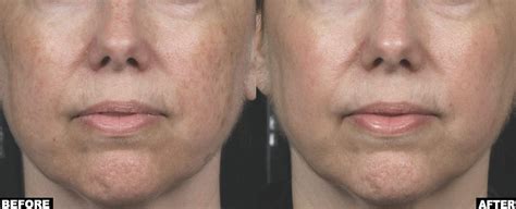 Non Ablative Laser Resurfacing Reef Recovery